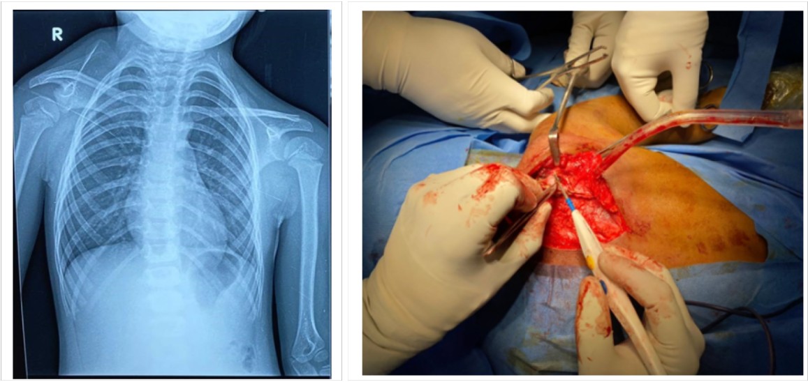 Surgical Correction of Sprengel Deformity of the Shoulder by Wood Ward’s Technique – A Case Report