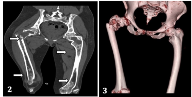 A Case Report of Polyostotic form of Fibrous Dysplasia: Imaging Features in Radiograph, Computed Tomography and Magnetic Resonance Imaging