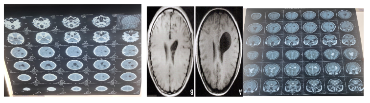 Intraventricular Neurocystecercosis with Psychiatry Manifestations