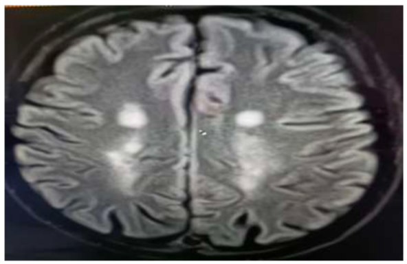 Neuromyelitis Optica Spectrum Disorder: A Rare Case Report
