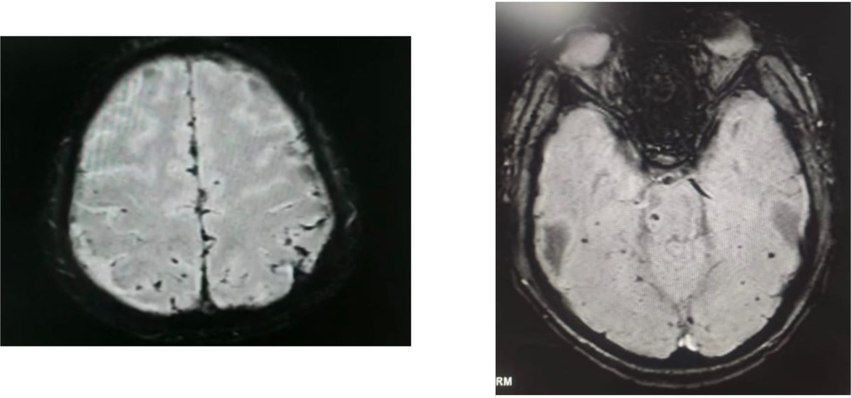 Intracranial Haemorrhage — A Life Threatening Consequence of Venom Induced Consumption Coagulopathy in Snake Bite: A Rare Case Report