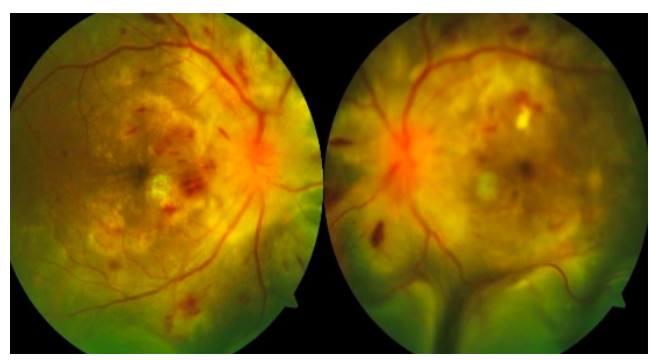 Bilateral Exudative Retinal Detachment Secondary to Malignant Hypertension – A Case Report
