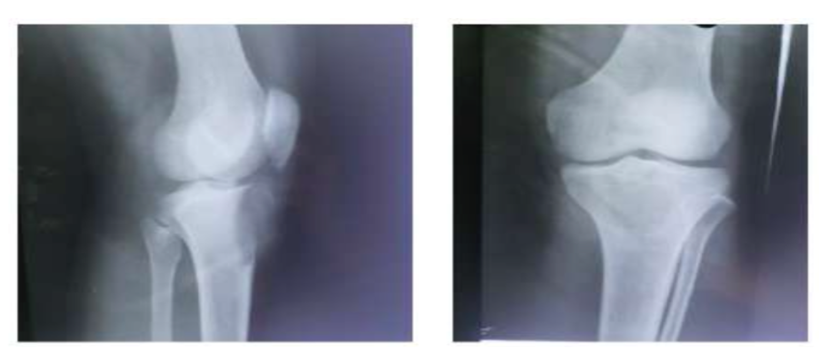 Giant Cell Tumour of Medial Condyle of Left Tibia