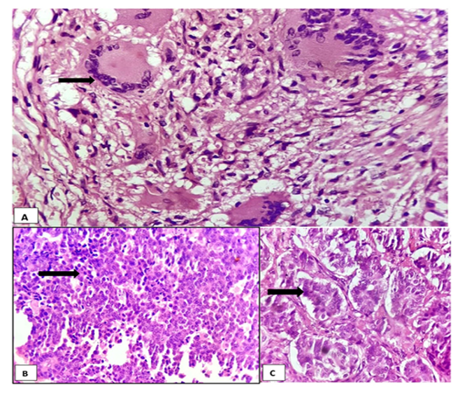 Spectrum of Histopathological Lesions in Appendicectomy Specimens