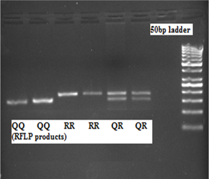 Association of PON-1 Genes (Q192R and L55M) Polymorphism with Cardiovascular Disease in Type 2 Diabetes Mellitus in Indian Population