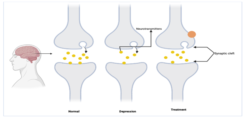 Understanding Silent Eruptions of Depression among Youngsters and Adolescents